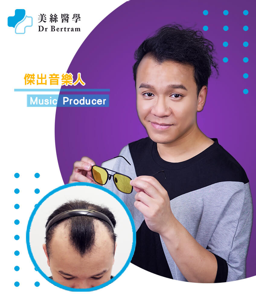 Hair restoration clinical result