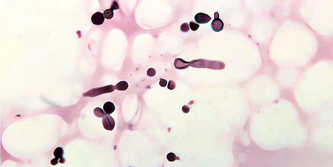 Malassezia yeast - the cause of skin inflammation