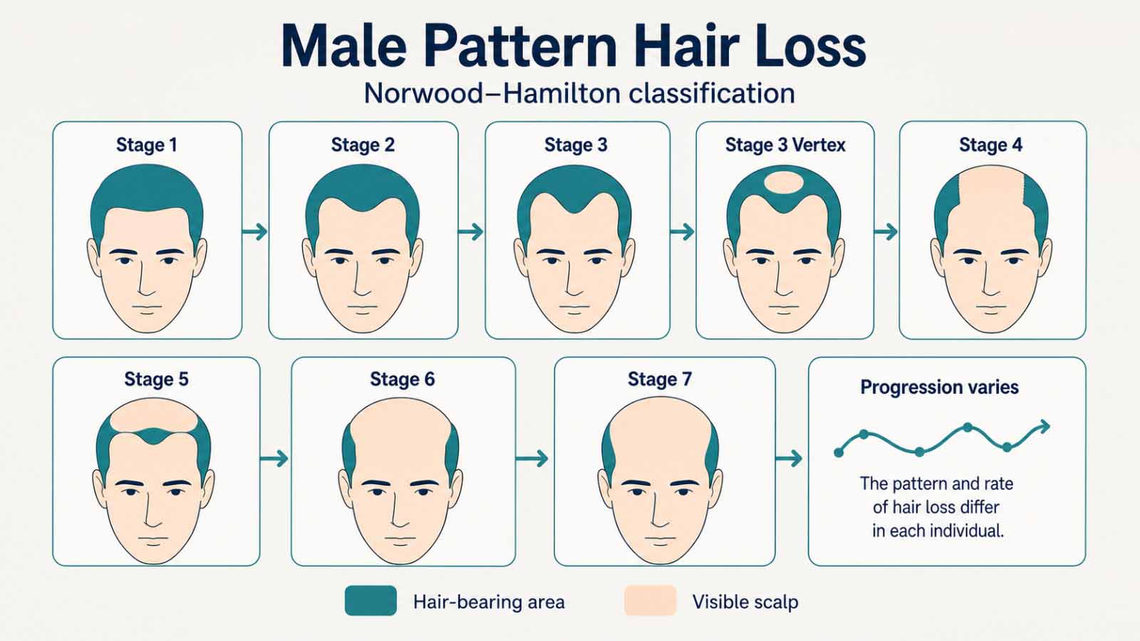Male Pattern Hair Loss Progression and Follicular Miniaturisation Diagram
