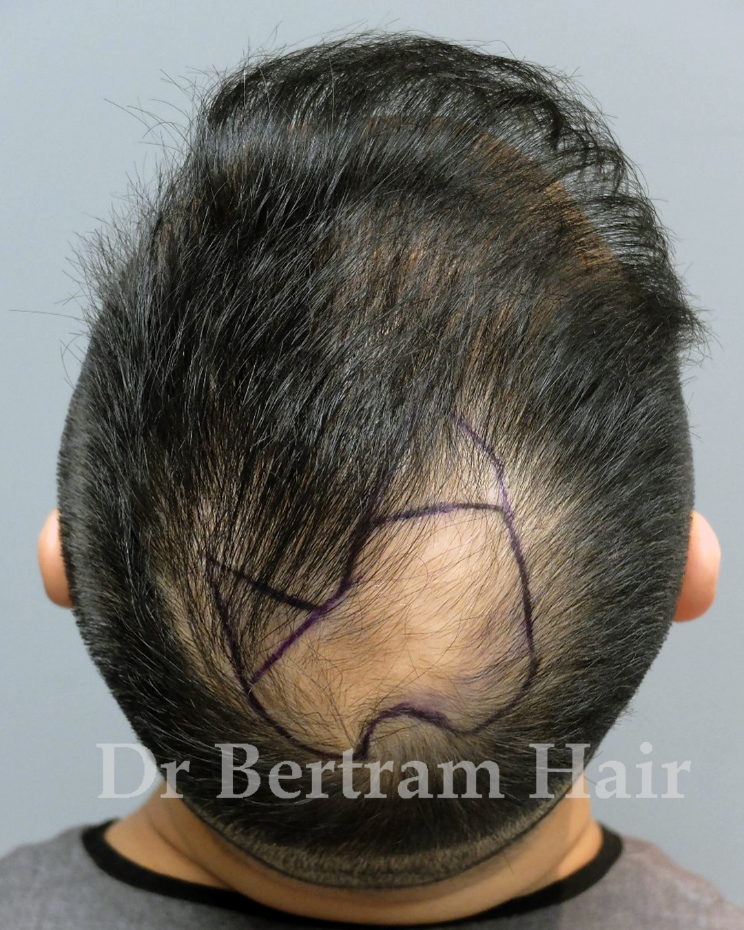 Pre-procedure area