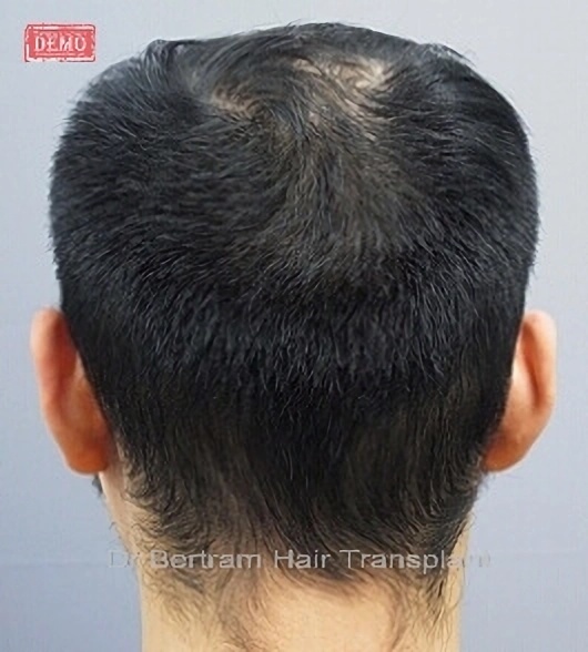 FUT scar covered by hair