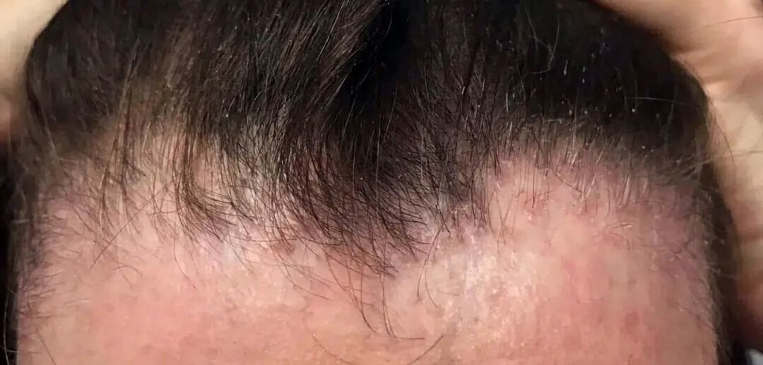 Traction alopecia hairline recession