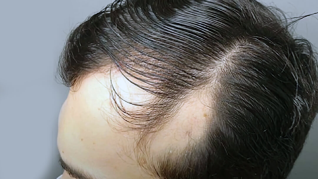 Triangular alopecia temporal patch