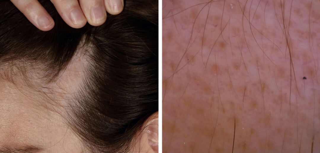 Triangular alopecia clinical presentation