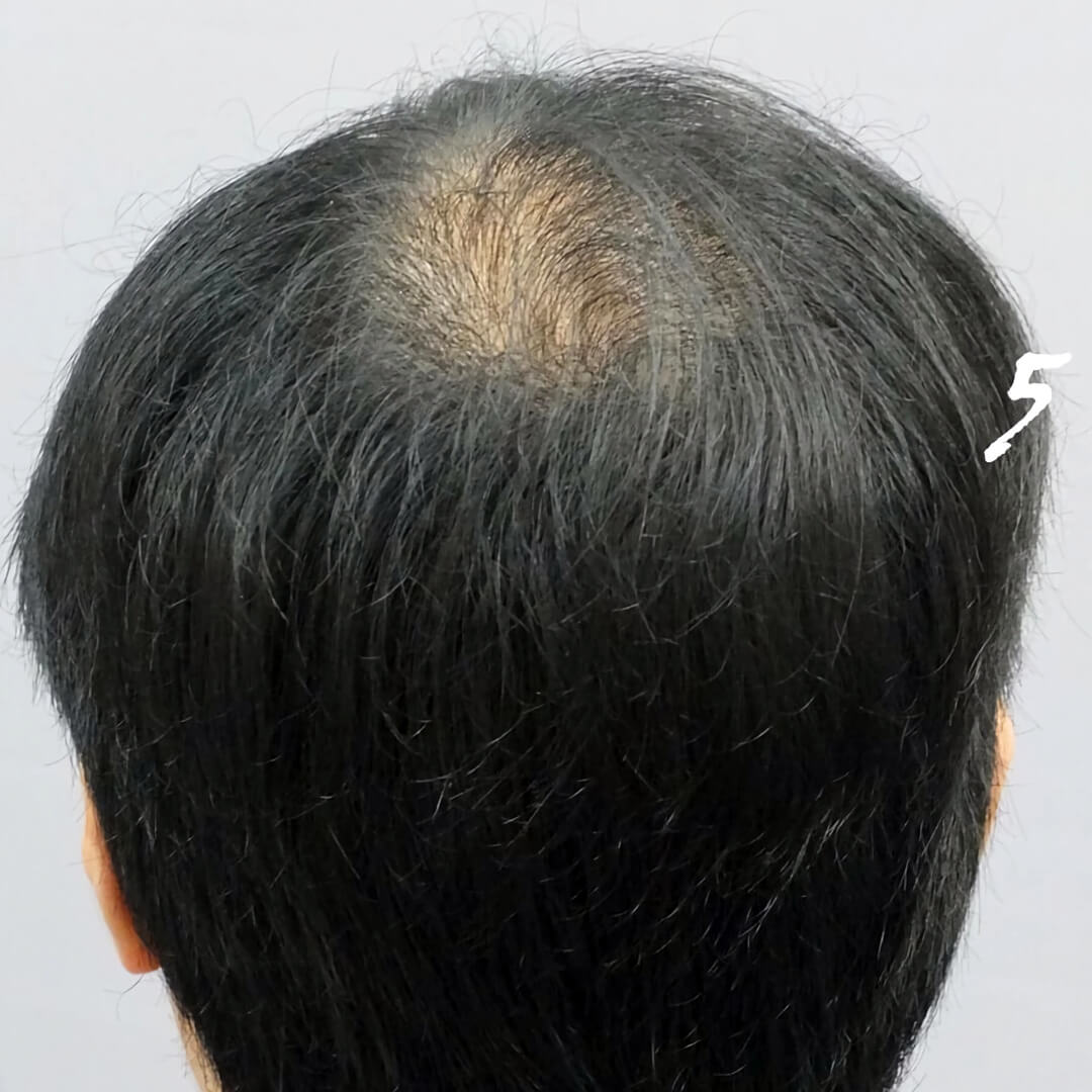 Back of head donor area